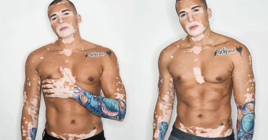 Brasileiro com vitiligo vence depressão, vira modelo e ganha o mundo