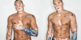 Brasileiro com vitiligo vence depressão, vira modelo e ganha o mundo